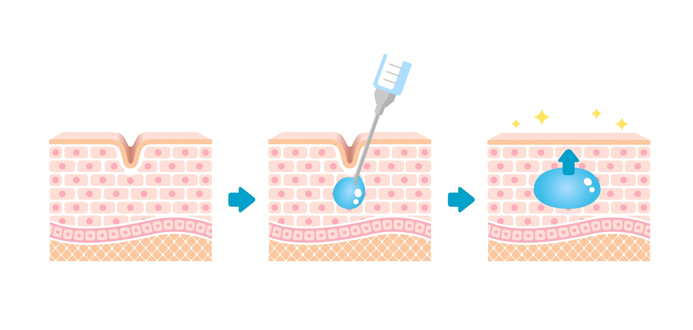 피부 구조4-리쥬란.jpg