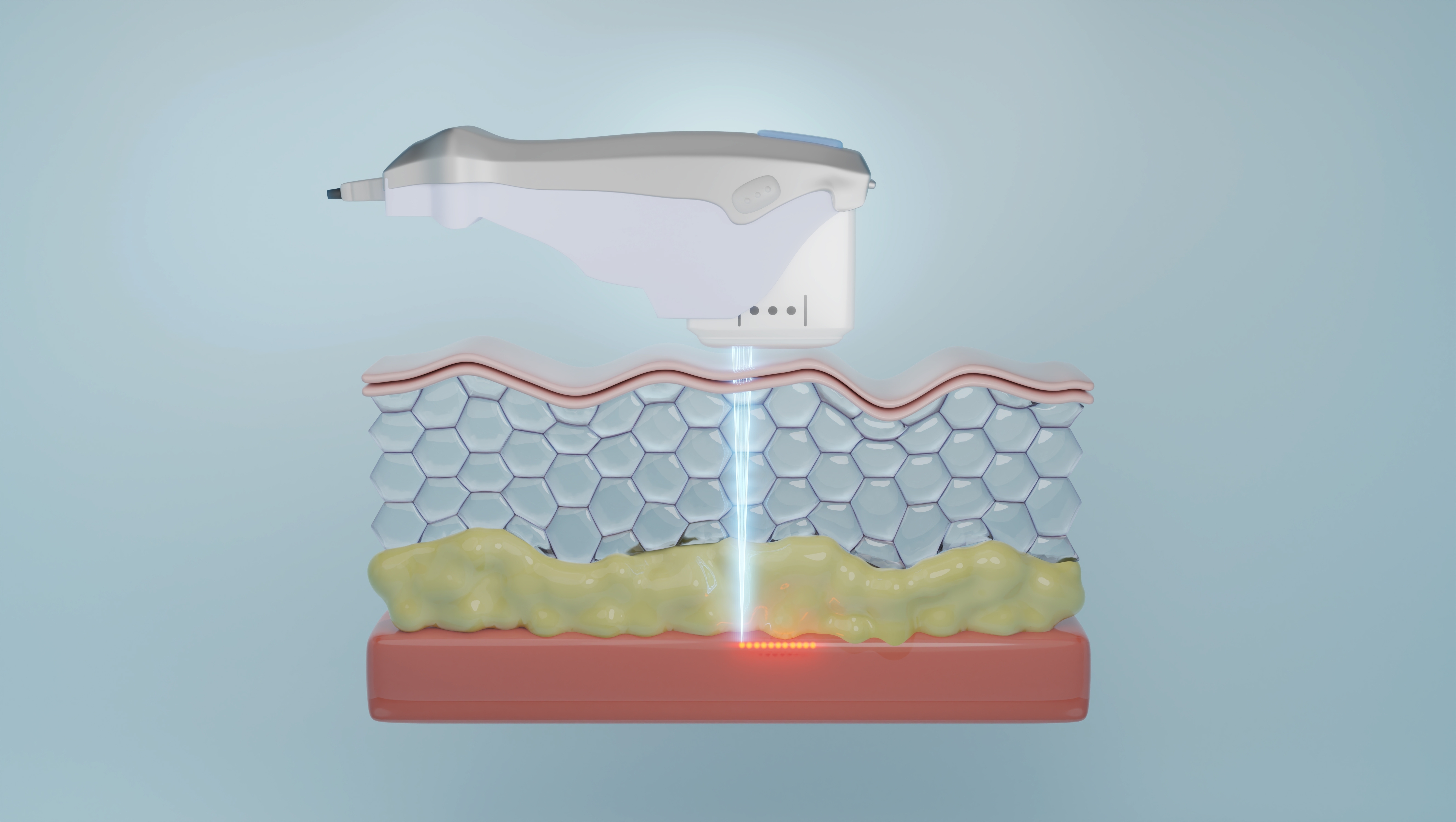 SMAS층 (HIFU) - HIFU.jpg