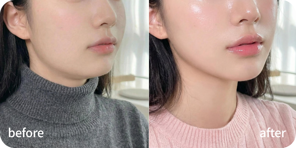 온다리프팅 B&A.png