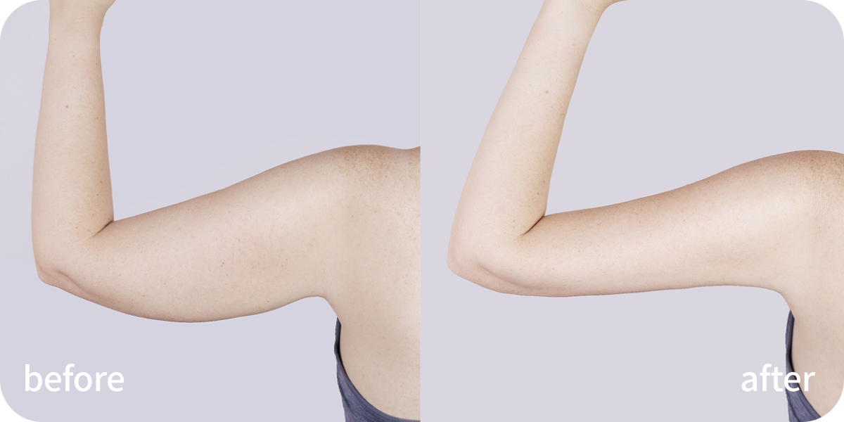 지방분해 B&A.png