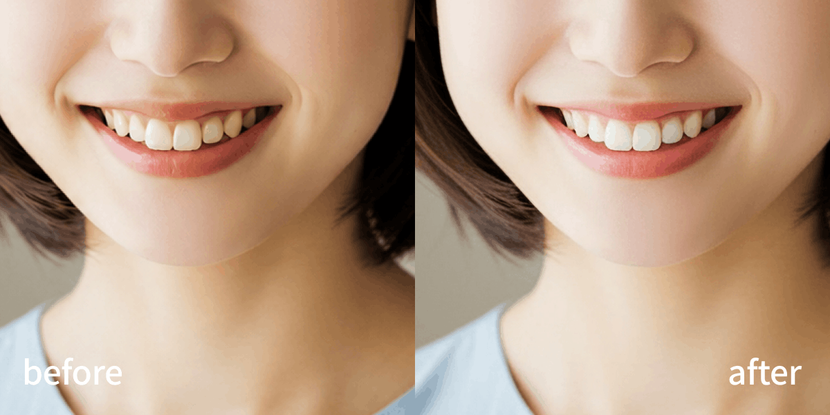미백 B&A.png