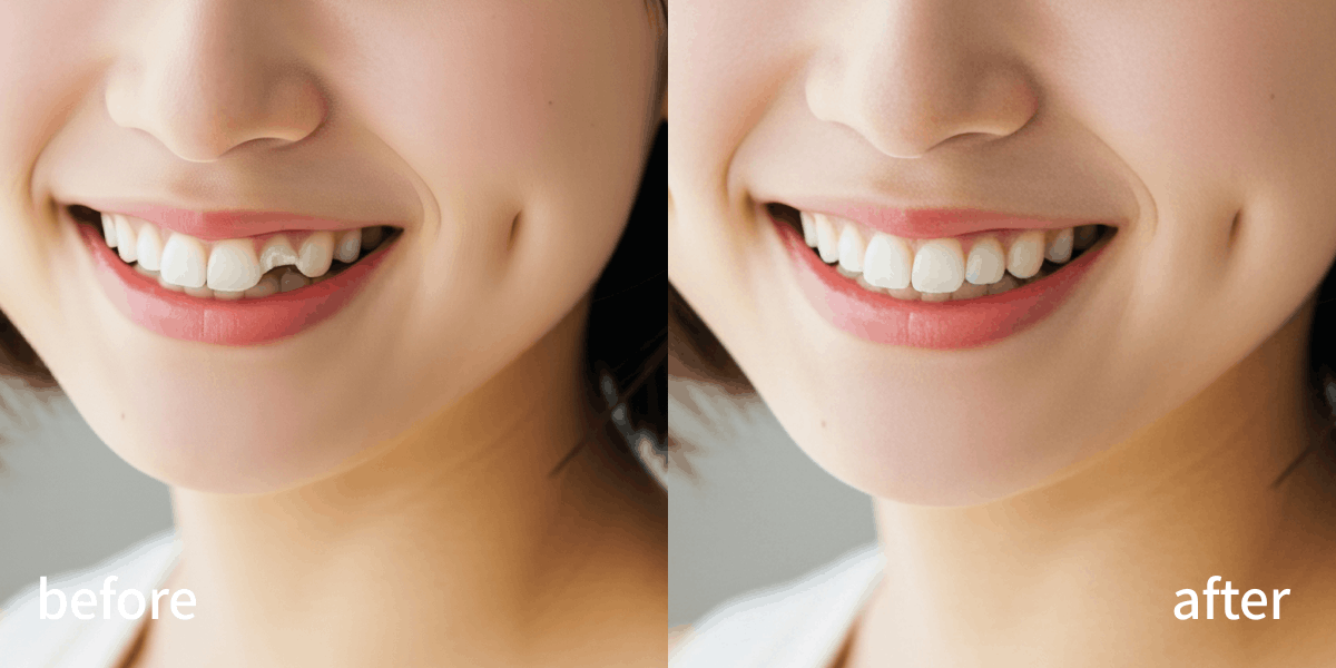 임플란트 B&A.png
