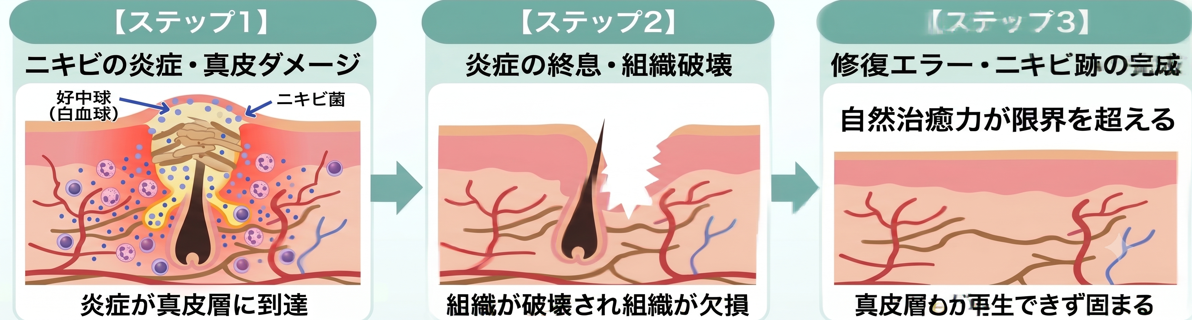 ニキビ跡になる3ステップ.png
