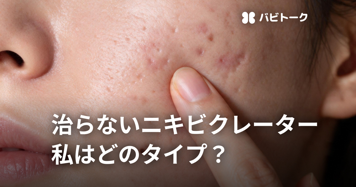 何をやっても消えないクレーター肌…受けるなら？3タイプ別に治療法を解説